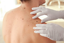 Foto prevenzione melanoma.jpg - {Foto prevenzione melanoma.jpg} - [100362]