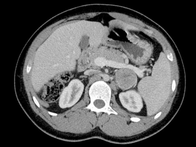 tumore_surrene_endocrinologiaoggi_roma_1060x796.jpg - {tumore_surrene_endocrinologiaoggi_roma_1060x796.jpg} - [136171]