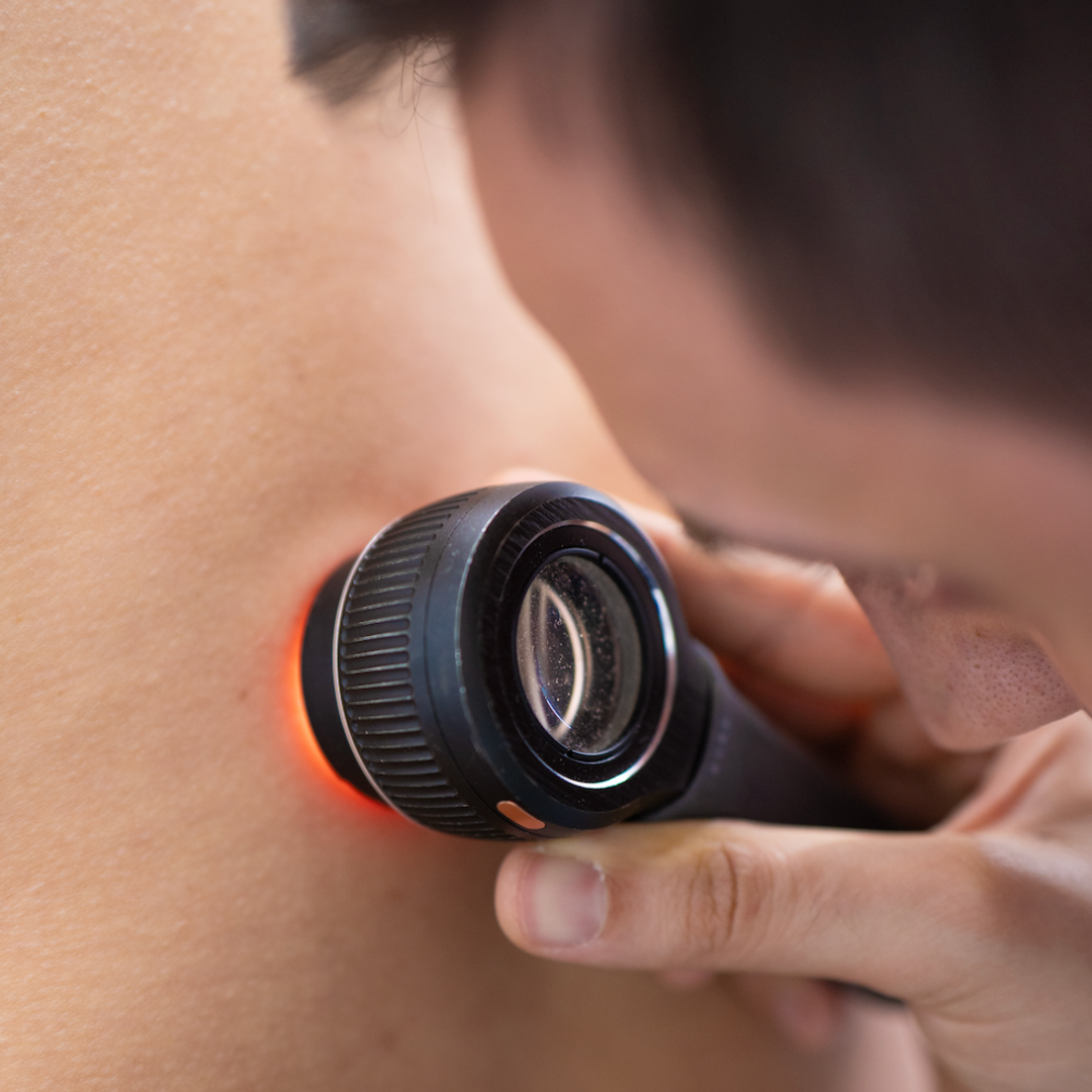 Melanoma.png - {Melanoma.png} - [143809]