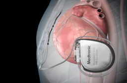 Nella foto il defibrillatore intratoracico.jpg - {Nella foto il defibrillatore intratoracico.jpg} - [50852]