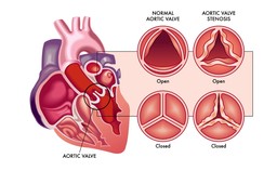 stenosi valvolare aortica.jpg - {stenosi valvolare aortica.jpg} - [70988]